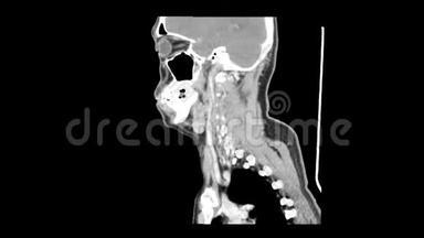 颈部侧视平滑运动CT扫描